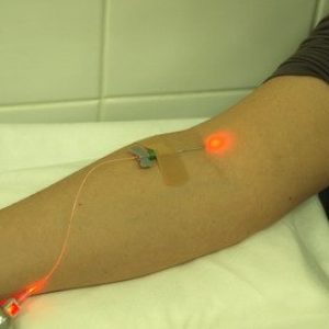 Внутривенное лазерное облучение крови